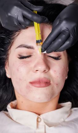From Acne to Radiance: How Microneedling Reshaped My Skin Journey